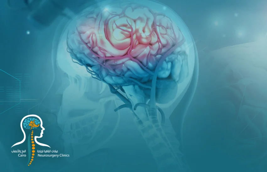 كيفية علاج نزيف المخ في عيادات نيرو سيرجري